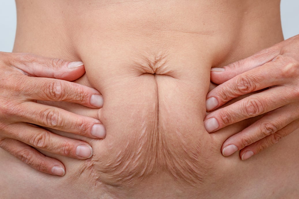 Hands on belly pressed skin to show sagging skin after diet and stretch marks after pregnancy